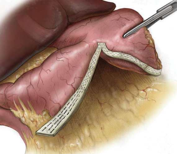 Image of staple line reinforcement with PSDV in sleeve gastrectomy